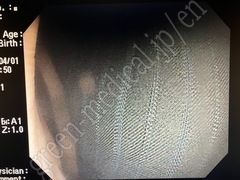 OLYMPUS Video Colonoscope