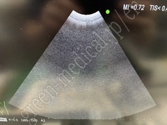 Hitachi Ultrasound Color Doppler