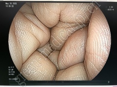 FUJIFILM Video Transnasal Gastroscope