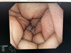 OLYMPUS Video Gastroscope