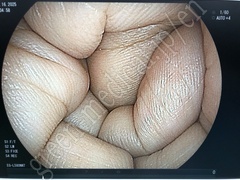 FUJIFILM Video Transnasal Gastroscope