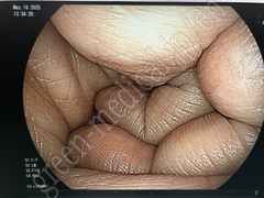 FUJIFILM Video Transnasal Gastroscope