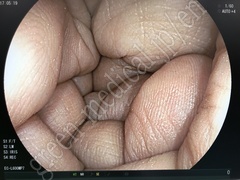 FUJIFILM Video Colonoscope