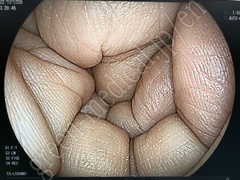 FUJIFILM Video Transnasal Gastroscope