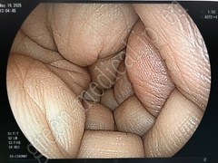 FUJIFILM Video Transnasal Gastroscope