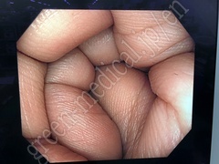 OLYMPUS Video Colonoscope