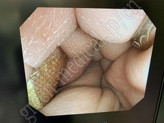 OLYMPUS Video Colonoscope