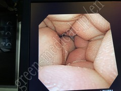 OLYMPUS Video Transnasal Gastroscope