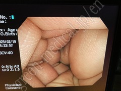 OLYMPUS Video Colonoscope