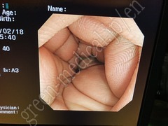 OLYMPUS Video Colonoscope