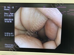 OLYMPUS Video Colonosope