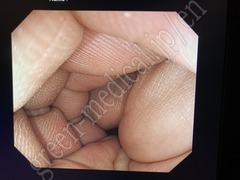 OLYMPUS Video Colonoscope