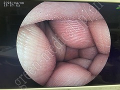 FUJIFILM Video Colonoscope
