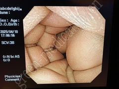 OLYMPUS Video Transnasal Gastroscope