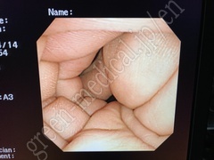 OLYMPUS Video Transnasal Gastroscope