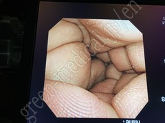 OLYMPUS Video Transnasal Gastroscope