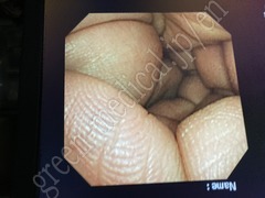 OLYMPUS Video Transnasal Gastroscope