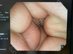 OLYMPUS Video Colonoscope