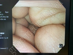 OLYMPUS Video Transnasal Gastroscope