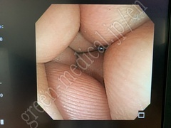 OLYMPUS Video Colonoscope