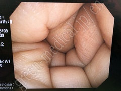 OLYMPUS Video Colonoscope