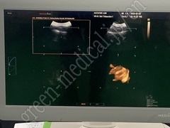 MEDISON Ultrasound Color Doppler
