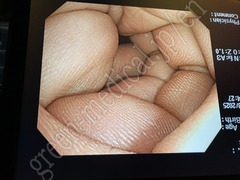 OLYMPUS Video Gastroscope