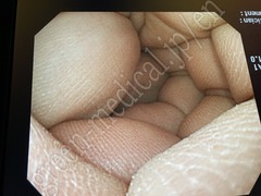 OLYMPUS Video Colonoscope