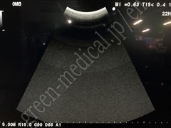 Hitachi Ultrasound Color Doppler