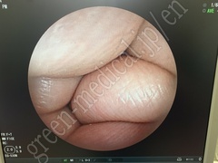 FUJIFILM Video Transnasal Gastroscope