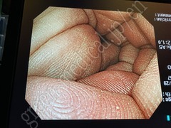 OLYMPUS Video Colonoscope