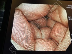 OLYMPUS Video Colonoscope