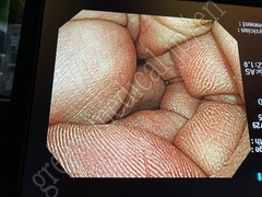 OLYMPUS Video Colonoscope