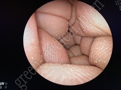 FUJIFILM Video Transnasal Gastroscope