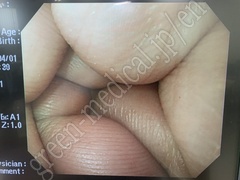 OLYMPUS Video Gastroscope