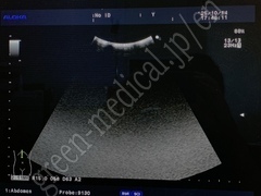Hitachi Ultrasound Color Doppler