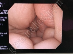 OLYMPUS Video Gastroscope