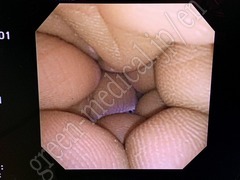 OLYMPUS Video Transnasal Gastroscope