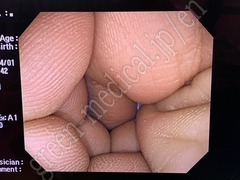 OLYMPUS Video Colonoscope