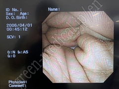 OLYMPUS Video Transnasal Gastroscope