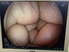 FUJIFILM Video Transnasal Gastroscope