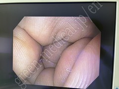 OLYMPUS Video Gastroscope