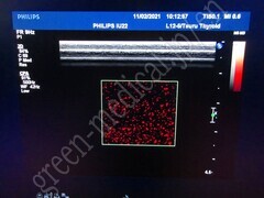 PHILIPS Ultrasound Color Doppler