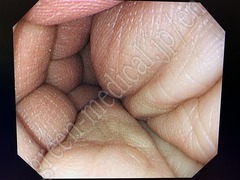 OLYMPUS Video Colonosope