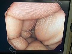 OLYMPUS Video Colonoscope