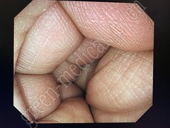 OLYMPUS Video Colonoscope