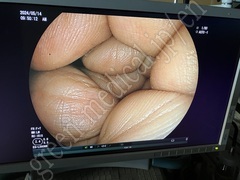 FUJIFILM Video Transnasal Gastroscope