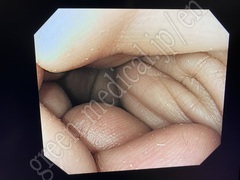 OLYMPUS Video Colonoscope