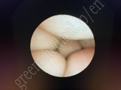 OLYMPUS Video-Fiber Bronchoscope