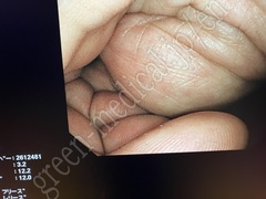 OLYMPUS Video Colonoscope